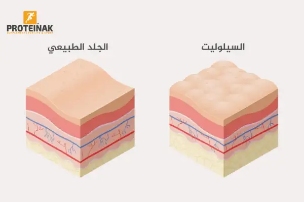 السيلوليت, الأسباب وطرق العلاج